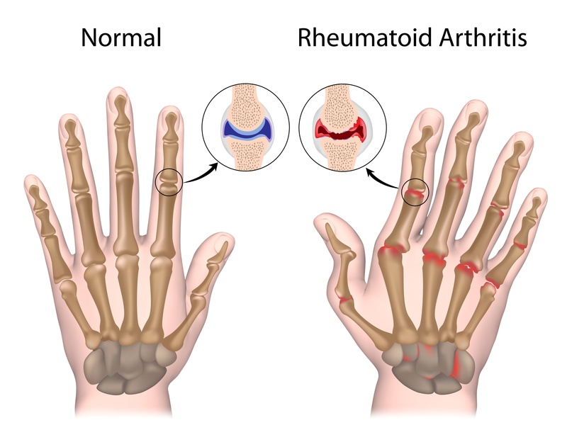 Exercising with Rheumatoid Arthritis